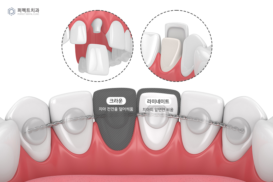 충치치료+교정 후 라미네이트, 세가지 복합적인 치료의 기간은?! 관련 이미지 4