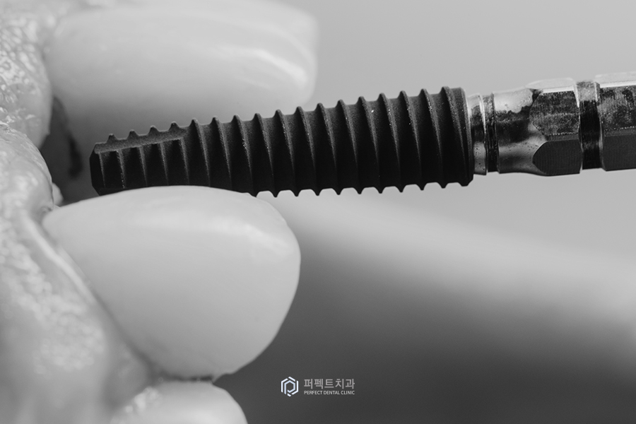 임플란트 한 번 심으면 평생 쓸 수 있나요?(1) 관련 이미지 1