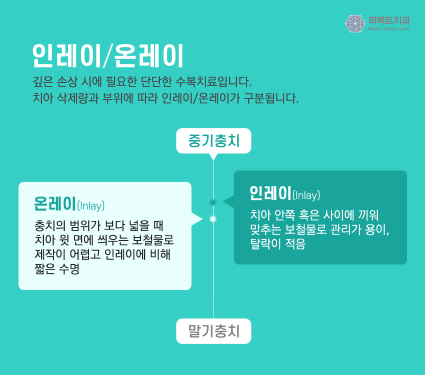 세라믹 인레이 충치치료 비용 관련 이미지 4