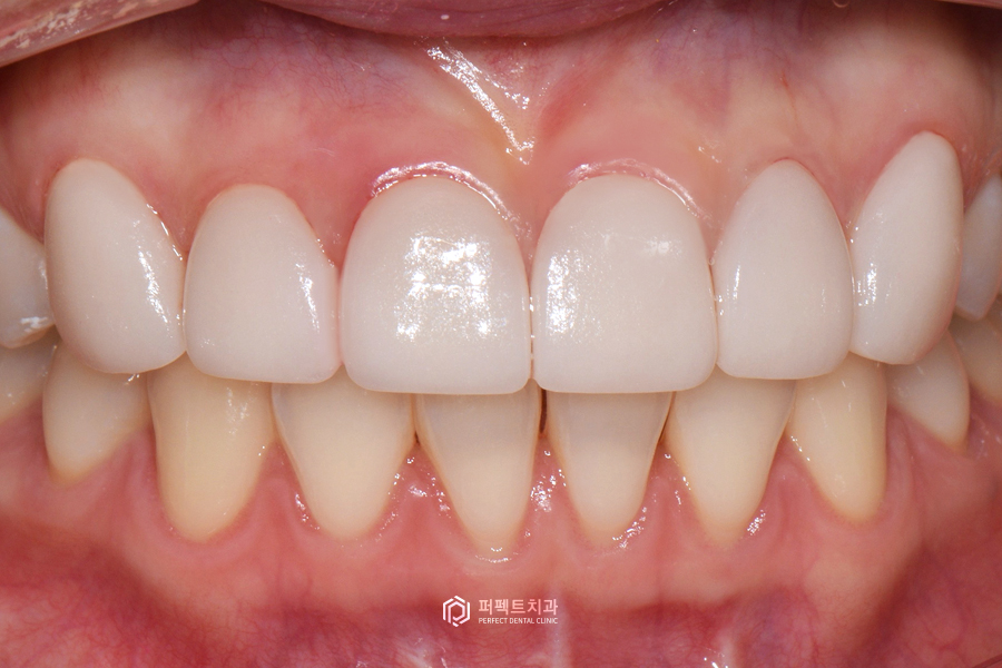 치아 모양 때문에 뻐드러져 보일 수 있다? 관련 이미지 3