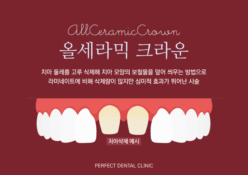 자연스러운 올세라믹 관련 이미지 1