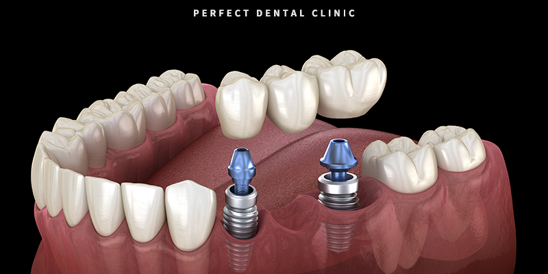 치과 앞니 브릿지 가격 관련 이미지 2