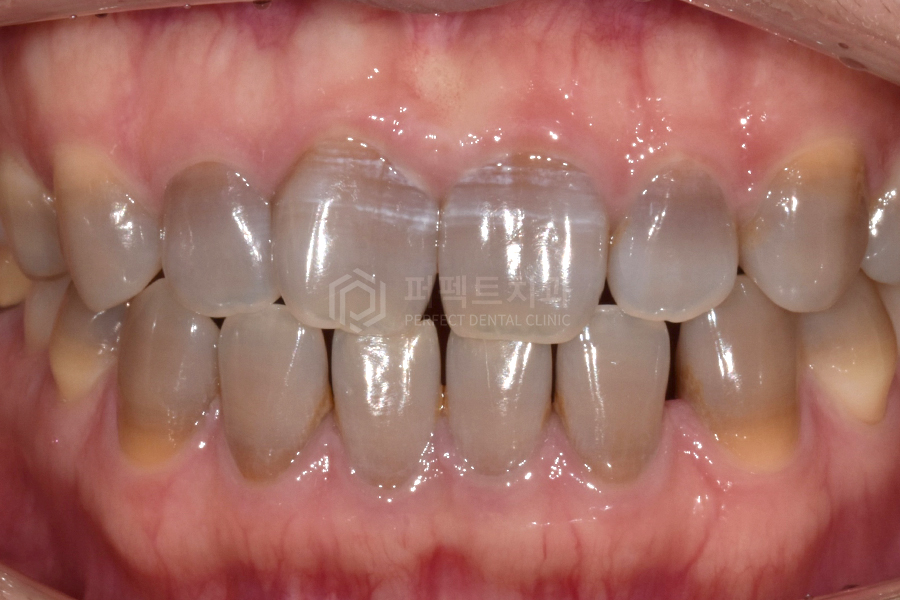 임신 중 치과치료｜부작용이 생길 수 있는 약물, 불소 사용은? 관련 이미지 1