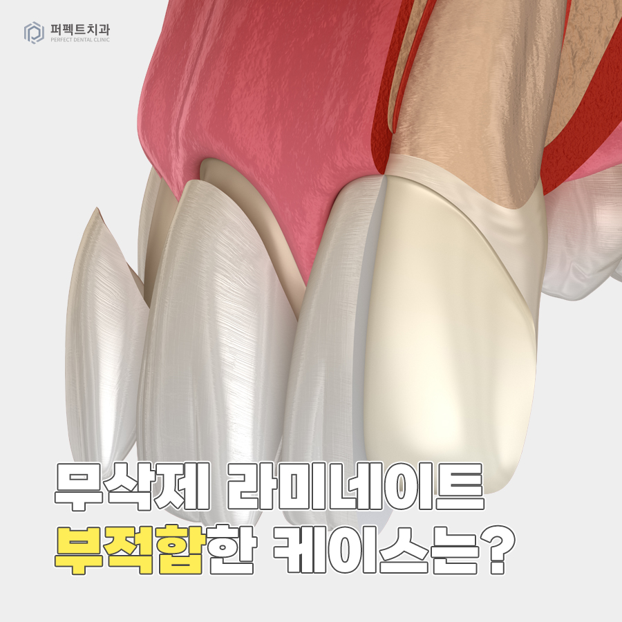 최소삭제, 무삭제 라미네이트가 적합하지 않은 경우는? 관련 이미지 1