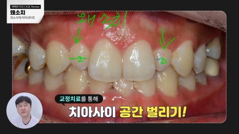 주변 치아보다 작은 관련 이미지 3