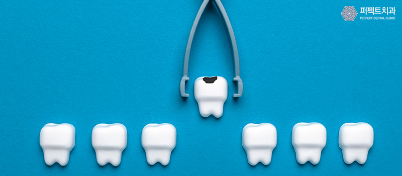 어금니 충치치료 방법 관련 이미지 1