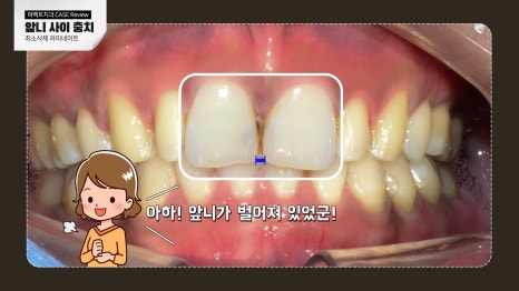 앞니 사이 충치치료와 폴리네이트 관련 이미지 7
