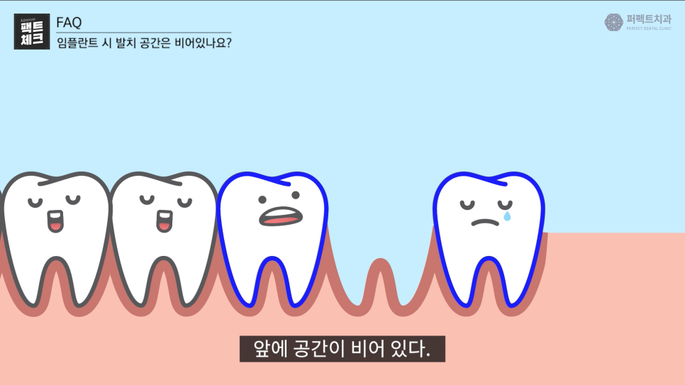 임플란트 후, 발치된 빈 공간이 걱정된다면? 관련 이미지 5