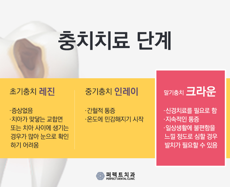 충치치료 치아크라운비용 관련 이미지 4