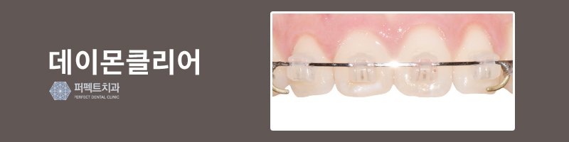 치아교정 클리피씨 교정으로 치료! 관련 이미지 3