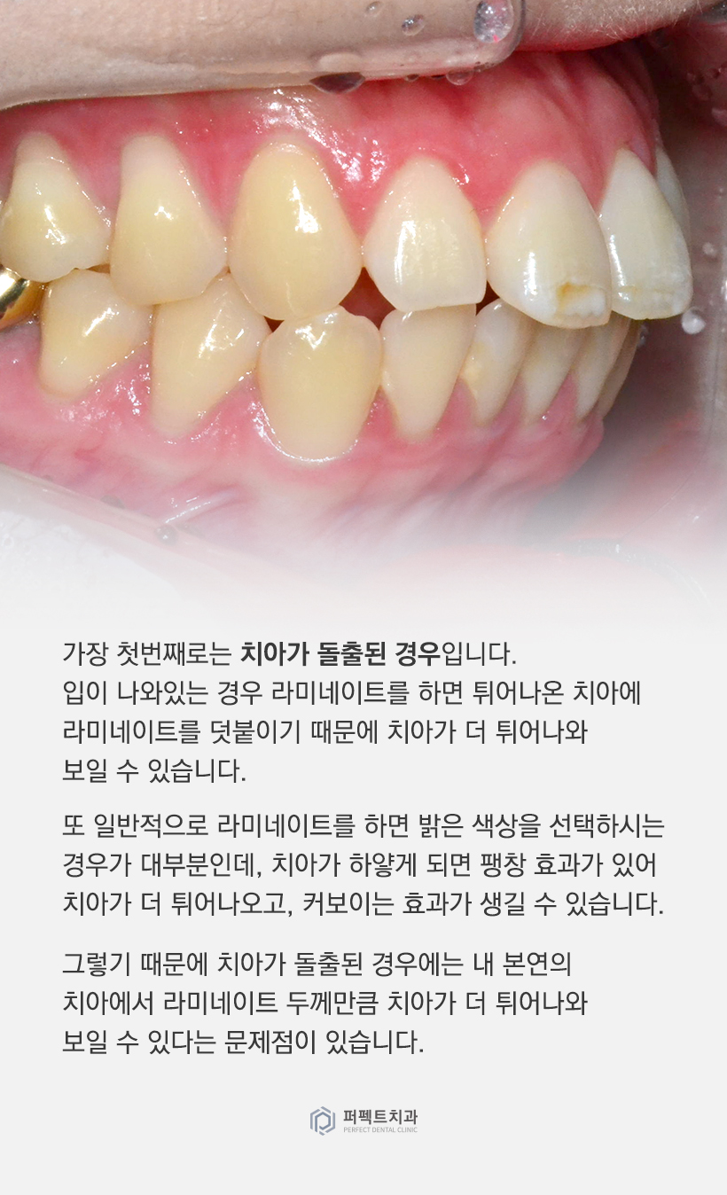 어떤 경우에 라미네이트를 하면 안되나요? 관련 이미지 1