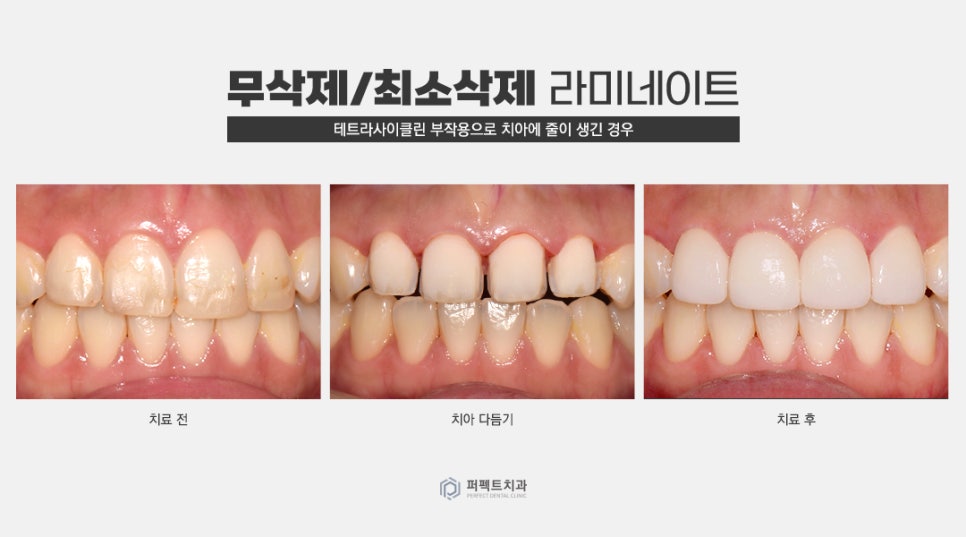 무삭제 라미네이트 추천 및 가능한 케이스 확인하기 관련 이미지 6