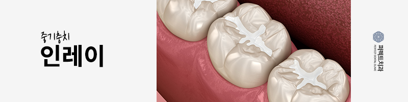 충치치료 레진 비용 얼마? 관련 이미지 3