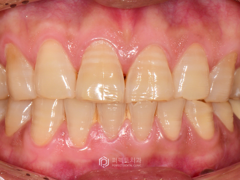 테트라사이클린 치아변색 폴리네이트 케이스 관련 이미지 2