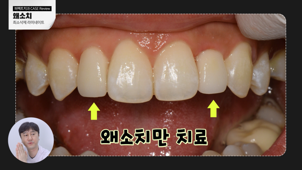 왜소치 라미네이트? 교정? 간단한 치료방법은 관련 이미지 6