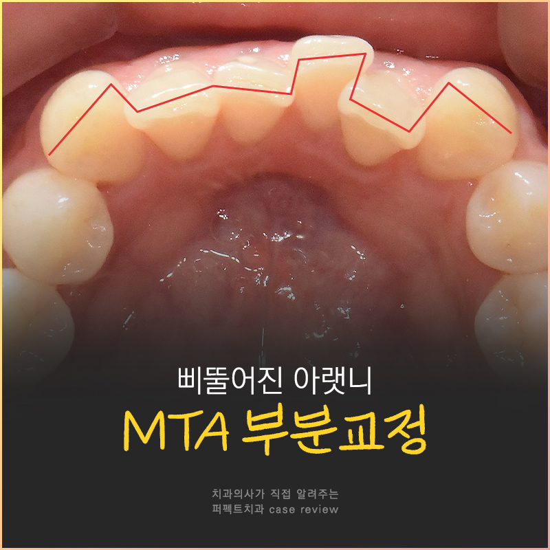 삐뚤거리는 아랫니를 6개월만에 반듯하게?! 관련 이미지 1