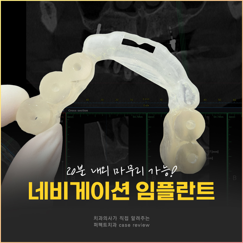 네비게이션 가이드로 전악임플란트를 20분만에? 관련 이미지 1