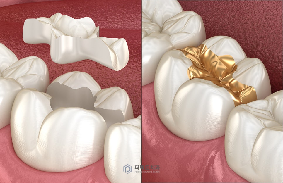 미룰수록 어려운 충치치료, 초기에 치료해요! 관련 이미지 6