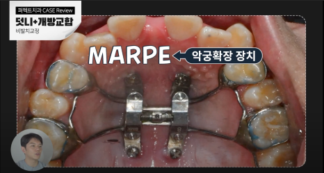 비발치로 덧니,개방교합 교정하기! 관련 이미지 4
