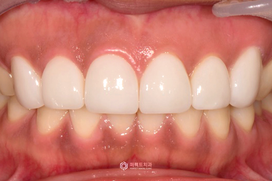 나비치아, 부분교정vs라미네이트 치과의사가 추천하는 방법은? 관련 이미지 9