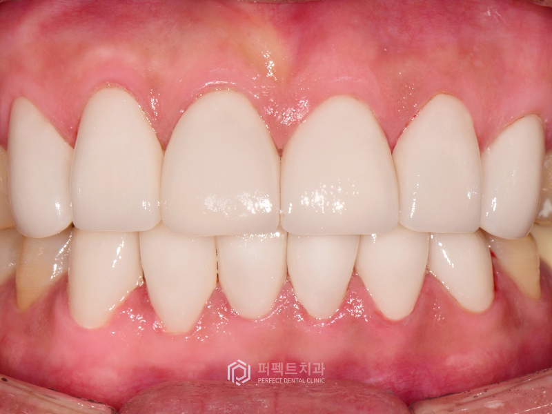 테트라사이클린 치아변색 폴리네이트 케이스 관련 이미지 5