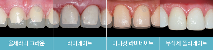 앞니라미네이트, 꼭 해야하는 이유 관련 이미지 2