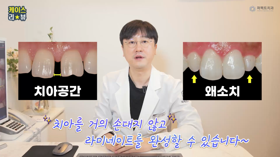 앞니충치, 벌어짐 동시에 치료하는 방법 관련 이미지 8