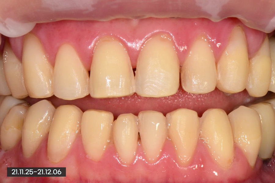 남자 라미네이트, 얼마나 밝게 가능할까? 관련 이미지 4
