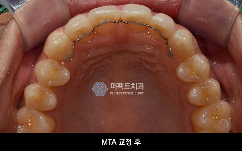 3개월 단기교정 비용과 기간은? 관련 이미지 4