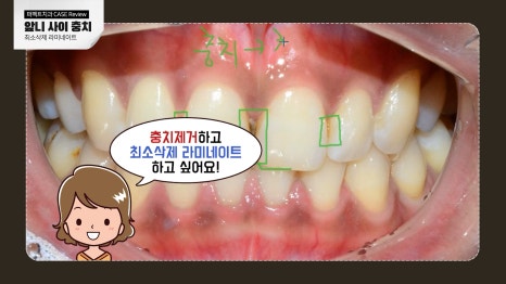 앞니 사이 충치치료와 폴리네이트 관련 이미지 4