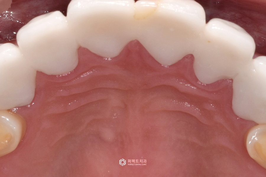 치료해도 자꾸 벌어지는 치아..😨 원인은? 관련 이미지 9