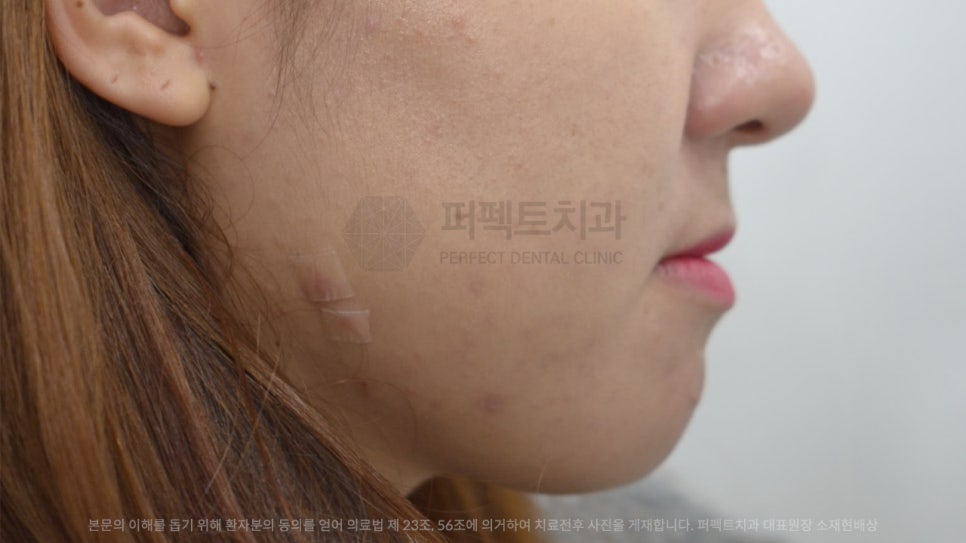 개방교합 주걱턱 교정 후기 관련 이미지 1