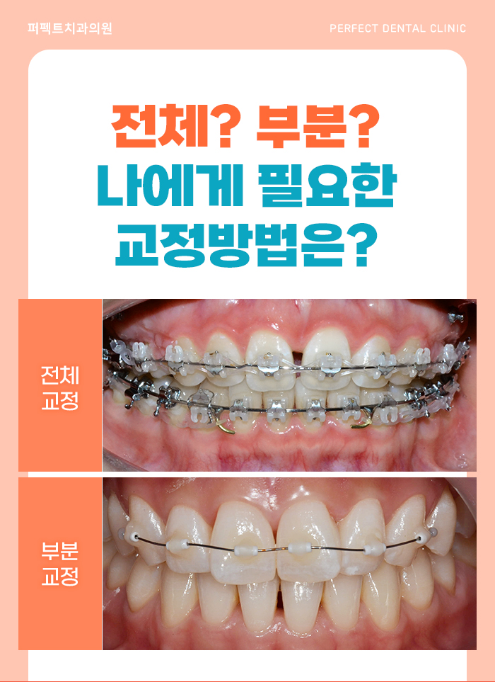 치아교정, 치료 시 참고사항은? 관련 이미지 7