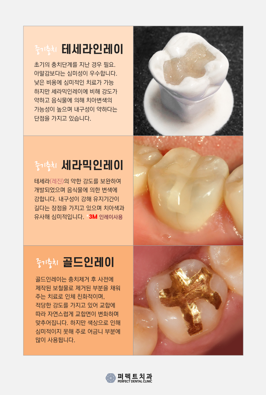강남치과 충치 인레이 비용 관련 이미지 5