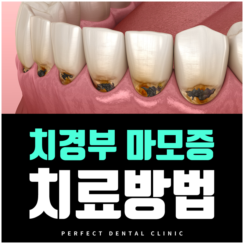치경부마모증 원인과 치료방법! 관련 이미지 1
