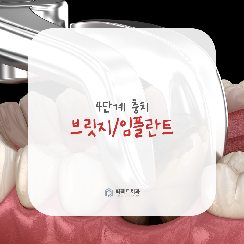 충치치료 단계와 치료방법 알아보기 관련 이미지 6