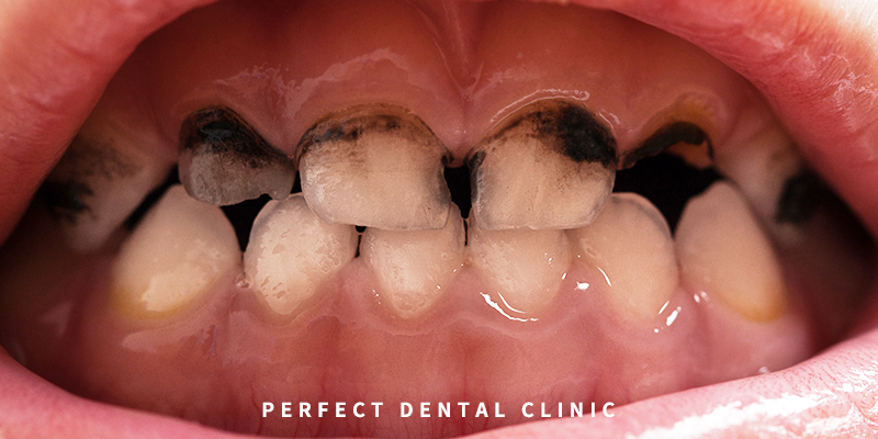 치과 충치치료비용 알고가기! 관련 이미지 2