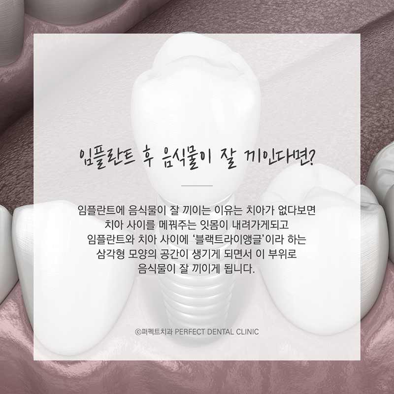임플란트 후 식사는 어떻게 하나요? 관련 이미지 5