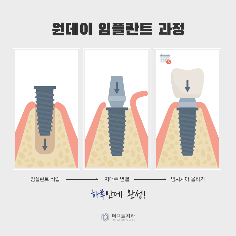 컴퓨터 분석을 통한 임플란트 관련 이미지 8
