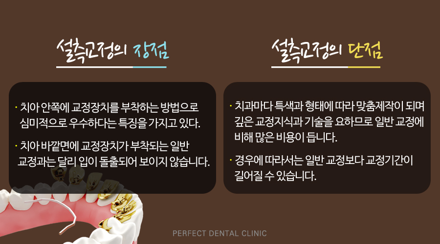 치아안쪽에 부착하는 설측교정! 관련 이미지 7