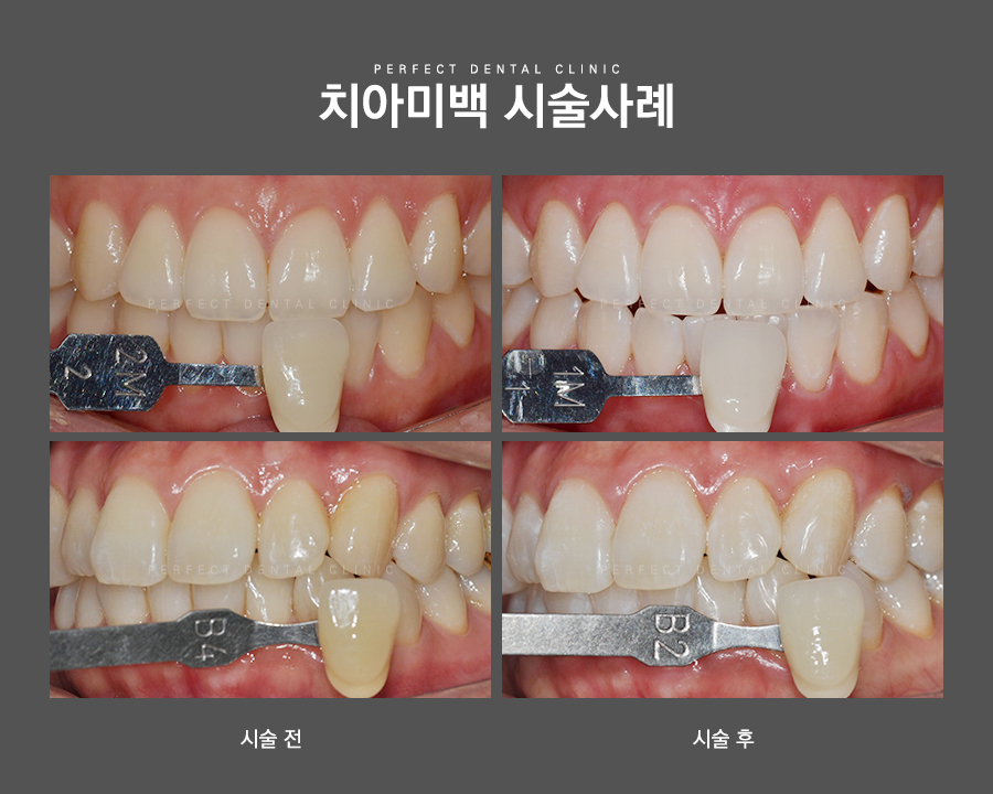 치아미백 후 이런 것들을 주의해주세요! 관련 이미지 3