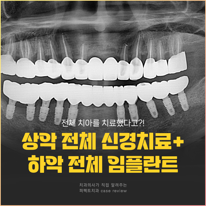 윗니 전체 신경치료 했다고?😱 교합평면이 뭐길래 관련 이미지 1