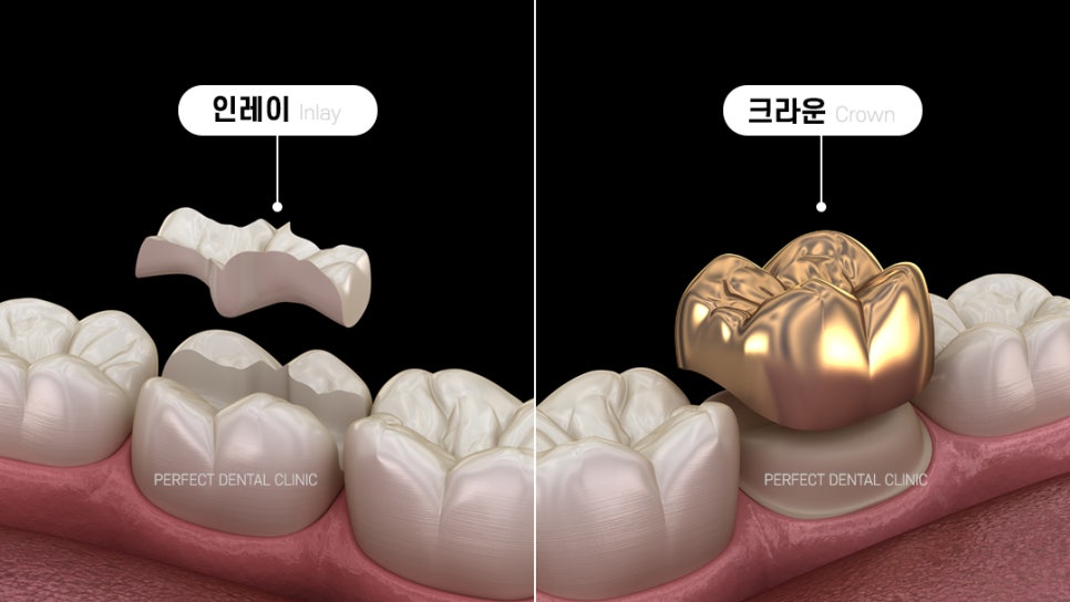 임시치아가 떨어졌어요! 관련 이미지 2