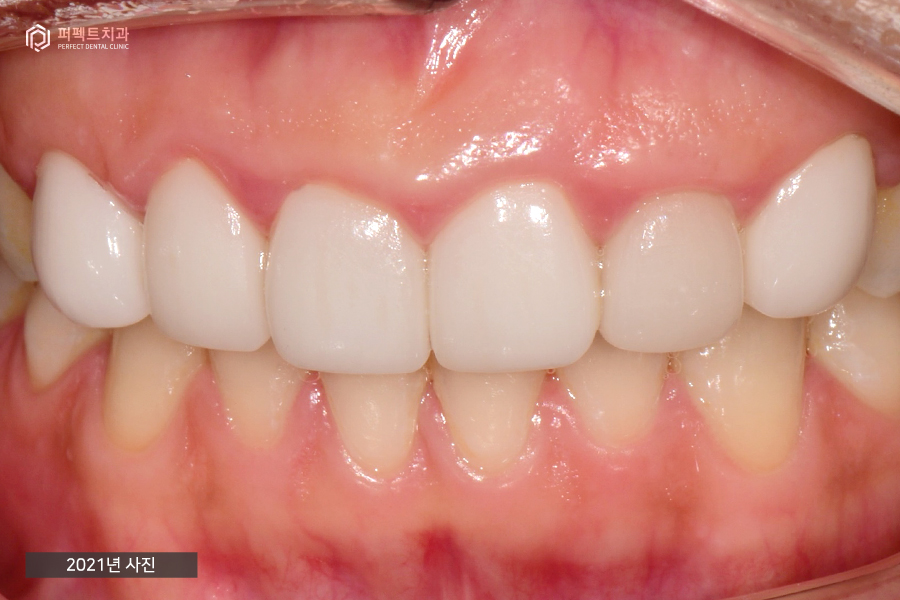 충치치료+교정 후 라미네이트, 세가지 복합적인 치료의 기간은?! 관련 이미지 6