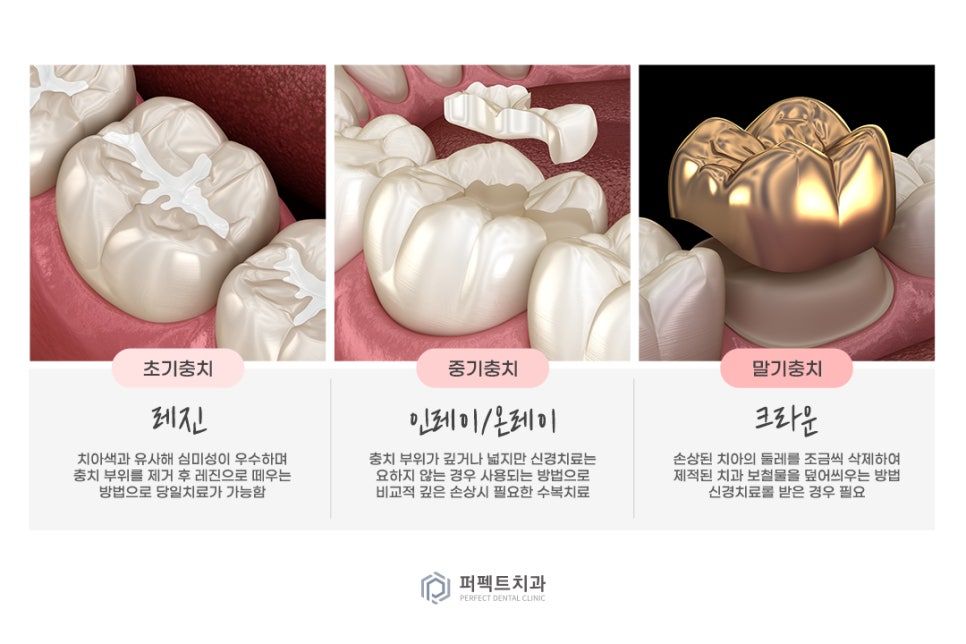 미룰수록 어려운 충치치료, 초기에 치료해요! 관련 이미지 4