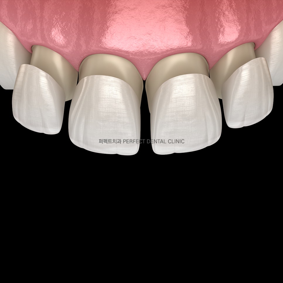 라미네이트 후 치아교정 가능한가요? 관련 이미지 3
