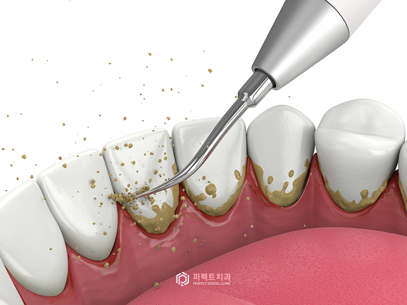 #1탄_의료보험 적용되는 치과치료는?(스케일링편) 관련 이미지 2