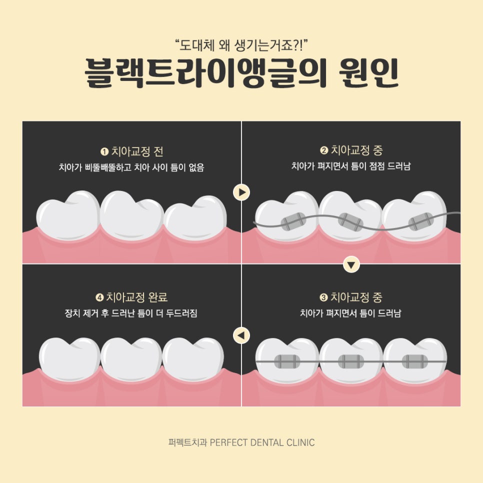치아교정을 하면 꼭 블랙트라이앵글이 생기나요? 관련 이미지 3
