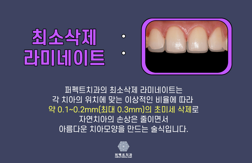 연예인 라미네이트 나도 할래!! 관련 이미지 5