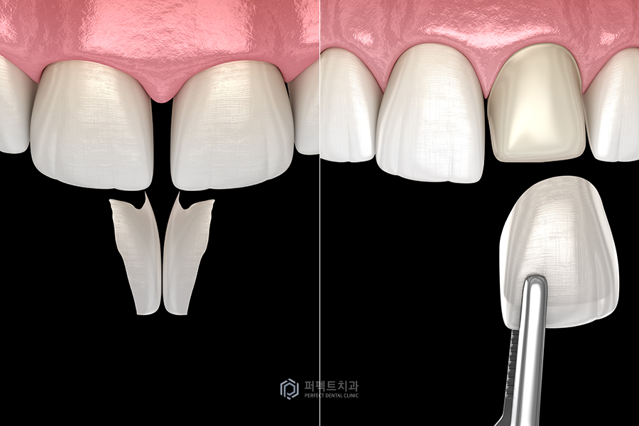 벌어진 앞니, 레진으로 치료 가능? 관련 이미지 2